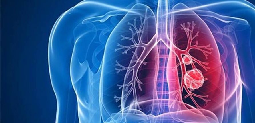Mitos e verdades sobre a Tuberculose